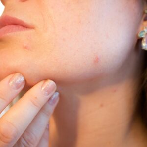 Coffrets Routine peaux acnéiques